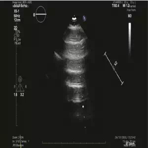 Lung US A-mode A line reverberations